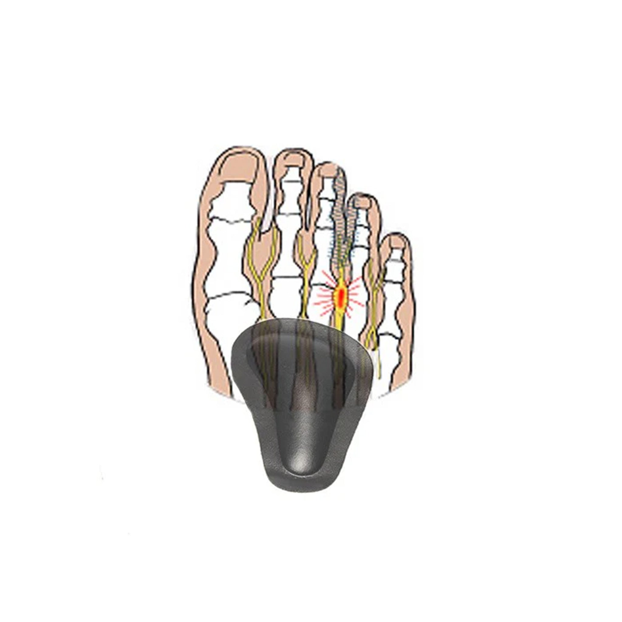 Selvklebende pelotter for nedsunket forfotbue