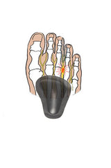 Selvklebende puter for innsunkne forfotbuer