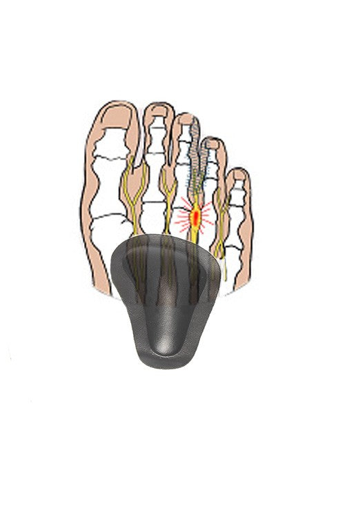 Selvklebende puter for innsunkne forfotbuer