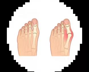 Hallux Valgus fot Hallux Valgus fot